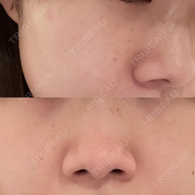 ピコレーザートーニング（美白・肝斑） / ピコフラクショナルレーザー（毛穴・ニキビ跡） ルラ美容クリニック 高田馬場院 AFTER メイン用