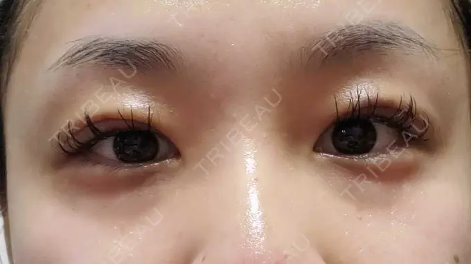 二重埋没 アリエル美容クリニック 郡山院 DAY 7 メイン用