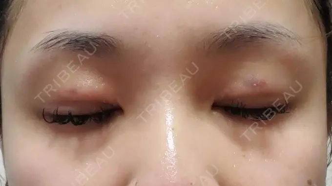 二重埋没 アリエル美容クリニック 郡山院 DAY 7 メイン用