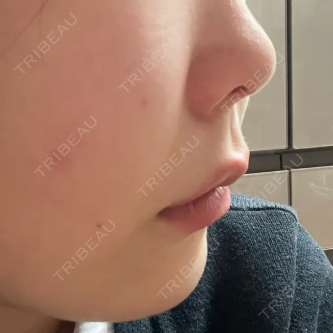 脂肪溶解注射（顔） アモーレクリニック 名古屋院 DAY 2 メイン用