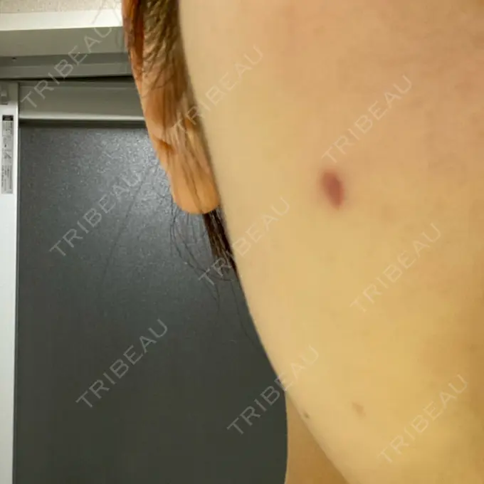 ほくろ・いぼ切除（肌） 吉祥寺アイビークリニック DAY 139 メイン用