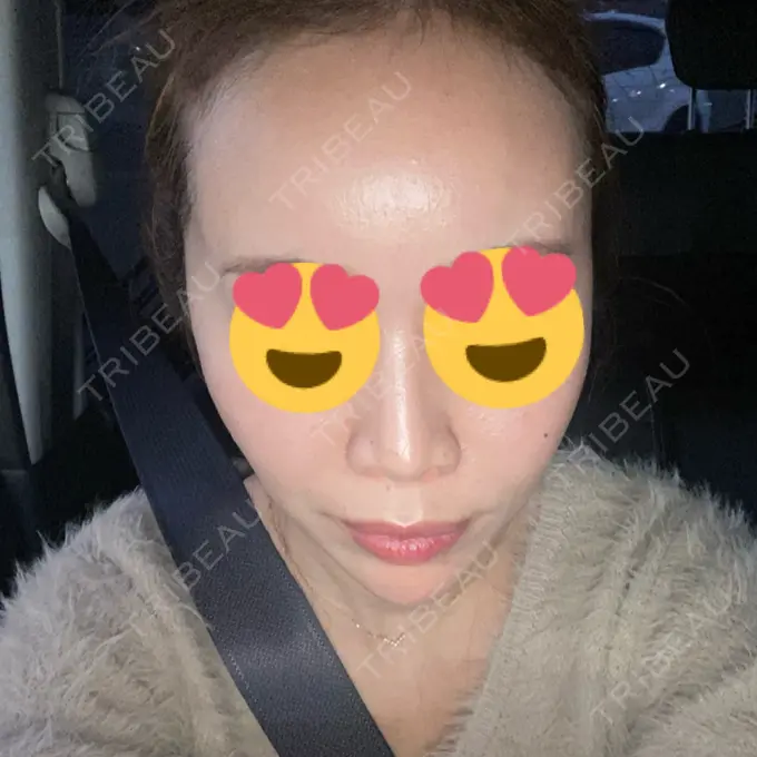 ヒアルロン酸注入（あご） / ヒアルロン酸注入（頬） フィラークリニック 名古屋栄院 AFTER メイン用