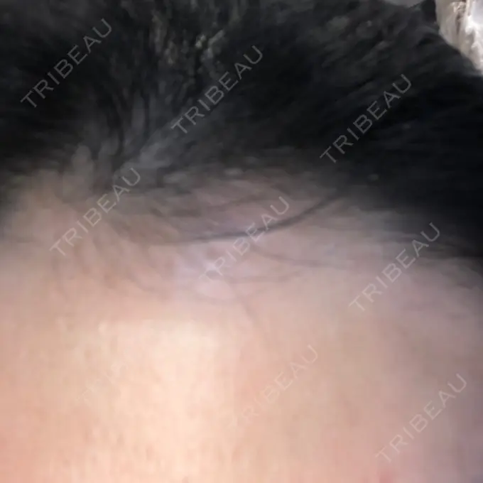 ダーマペン LIFIX BEAUTY CLINIC DAY 6 メイン用