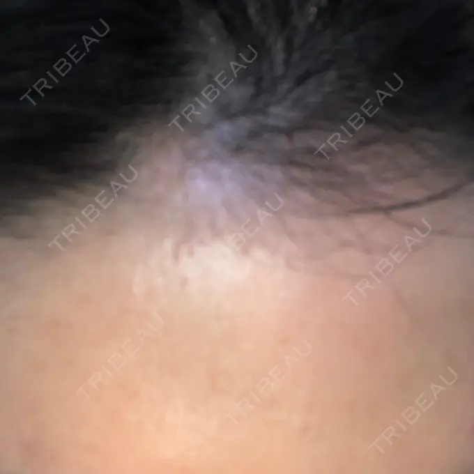 ダーマペン LIFIX BEAUTY CLINIC DAY 7 メイン用