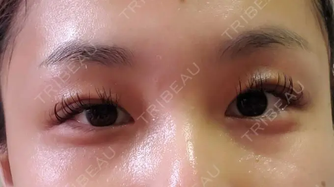 二重埋没 アリエル美容クリニック 郡山院 DAY 8 メイン用