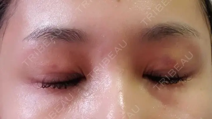 二重埋没 アリエル美容クリニック 郡山院 DAY 8 メイン用