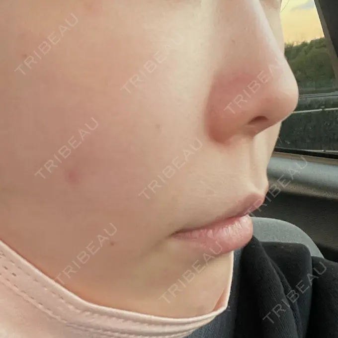 脂肪溶解注射（顔） アモーレクリニック 名古屋院 DAY 3 メイン用