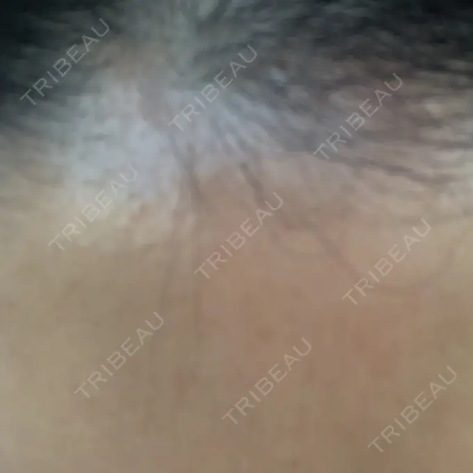 ダーマペン LIFIX BEAUTY CLINIC DAY 8 メイン用