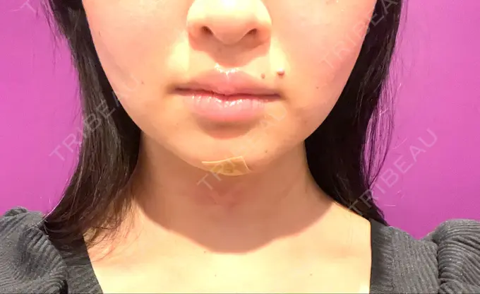 脂肪吸引（顔） / 下まぶたの脂肪取り / 脂肪注入（目の下） / ボトックス（エラ・小顔） WOM CLINIC GINZA （ワム クリニック ギンザ） DAY 1 メイン用