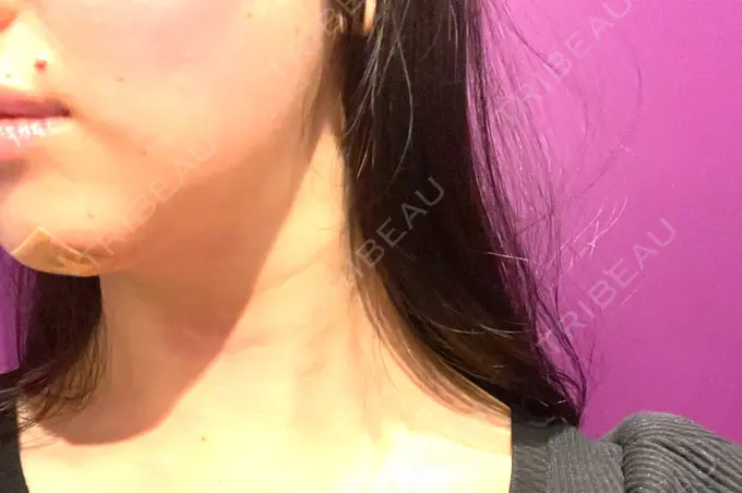 脂肪吸引（顔） / 下まぶたの脂肪取り / 脂肪注入（目の下） / ボトックス（エラ・小顔） WOM CLINIC GINZA （ワム クリニック ギンザ） DAY 1 メイン用