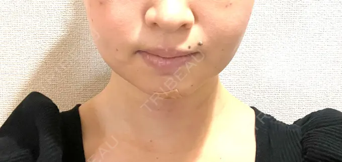 脂肪吸引（顔） / 下まぶたの脂肪取り / 脂肪注入（目の下） / ボトックス（エラ・小顔） WOM CLINIC GINZA （ワム クリニック ギンザ） DAY 2 メイン用