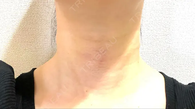 脂肪吸引（顔） / 下まぶたの脂肪取り / 脂肪注入（目の下） / ボトックス（エラ・小顔） WOM CLINIC GINZA （ワム クリニック ギンザ） DAY 2 メイン用