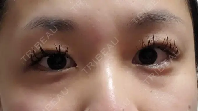 二重埋没 アリエル美容クリニック 郡山院 DAY 9 メイン用