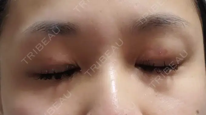 二重埋没 アリエル美容クリニック 郡山院 DAY 9 メイン用