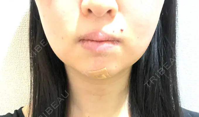 脂肪吸引（顔） / 下まぶたの脂肪取り / 脂肪注入（目の下） / ボトックス（エラ・小顔） WOM CLINIC GINZA （ワム クリニック ギンザ） DAY 3 メイン用