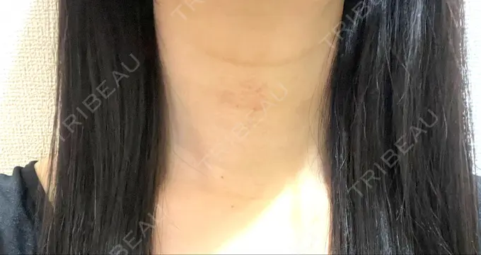 脂肪吸引（顔） / 下まぶたの脂肪取り / 脂肪注入（目の下） / ボトックス（エラ・小顔） WOM CLINIC GINZA （ワム クリニック ギンザ） DAY 3 メイン用