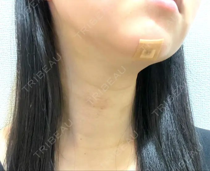 脂肪吸引（顔） / 下まぶたの脂肪取り / 脂肪注入（目の下） / ボトックス（エラ・小顔） WOM CLINIC GINZA （ワム クリニック ギンザ） DAY 3 メイン用