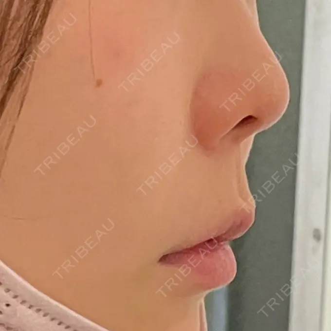 脂肪溶解注射（顔） アモーレクリニック 名古屋院 AFTER メイン用