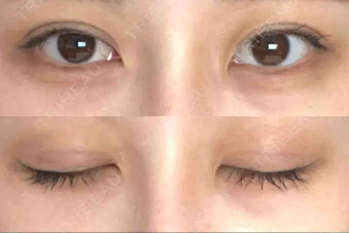 二重埋没 アリエル美容クリニック 郡山院 DAY 9 メイン用