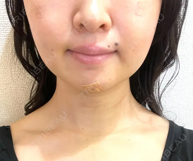 脂肪吸引（顔） / 下まぶたの脂肪取り / 脂肪注入（目の下） / ボトックス（エラ・小顔） WOM CLINIC GINZA （ワム クリニック ギンザ） AFTER メイン用