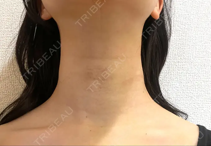 脂肪吸引（顔） / 下まぶたの脂肪取り / 脂肪注入（目の下） / ボトックス（エラ・小顔） WOM CLINIC GINZA （ワム クリニック ギンザ） DAY 4 メイン用