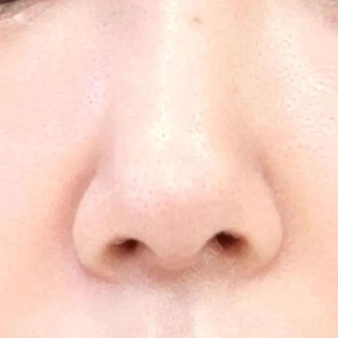 鼻尖形成（切開） / 鼻中隔延長（切開） / 鼻孔縁下降 / その他（目元） みずほクリニック DAY 10 メイン用