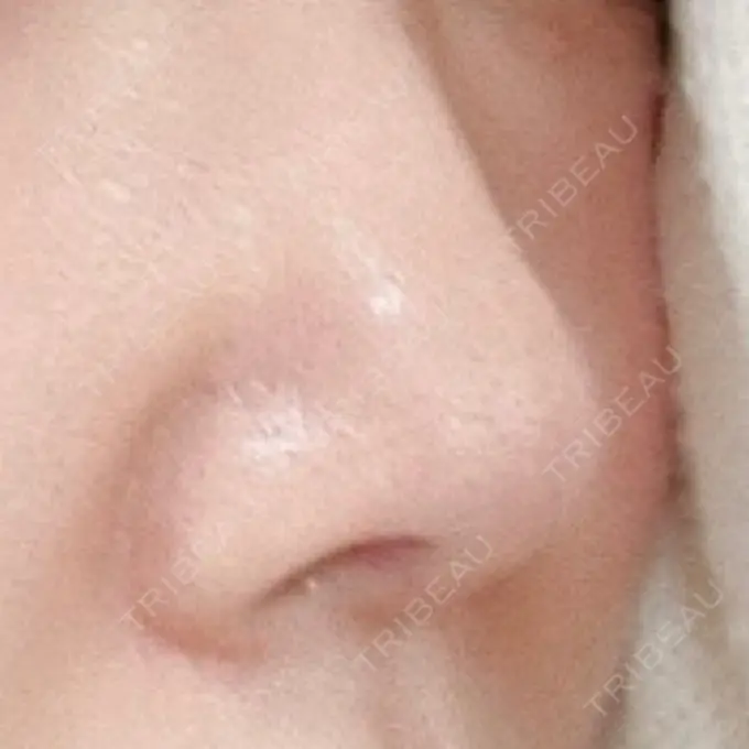 鼻尖形成（切開） / 鼻中隔延長（切開） / 鼻孔縁下降 / その他（目元） みずほクリニック DAY 10 メイン用