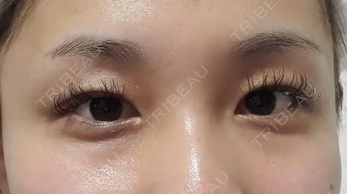 二重埋没 アリエル美容クリニック 郡山院 AFTER メイン用