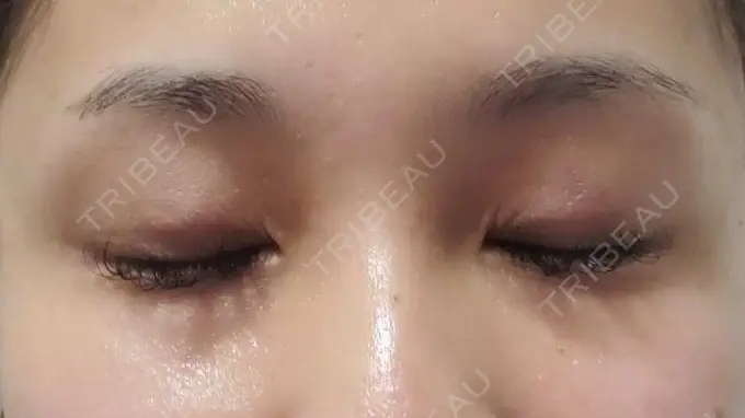 二重埋没 アリエル美容クリニック 郡山院 DAY 11 メイン用