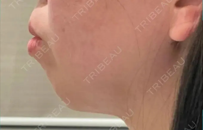 下まぶたの脂肪取り / その他（輪郭） 吉井クリニック DAY 28 メイン用