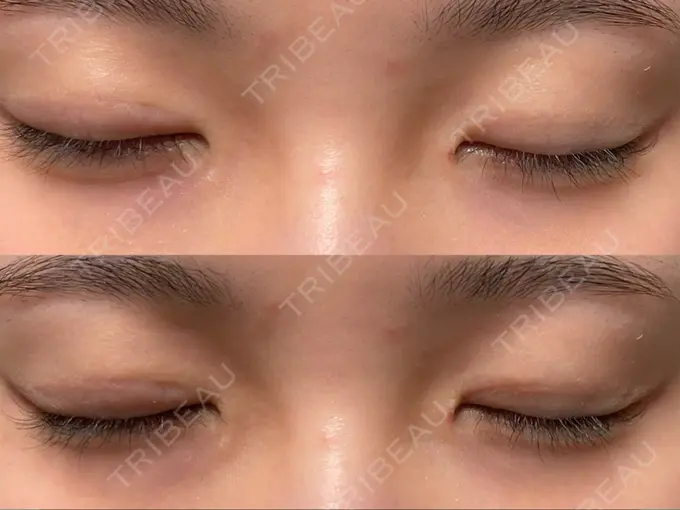 二重切開 こまちクリニック DAY 426 メイン用