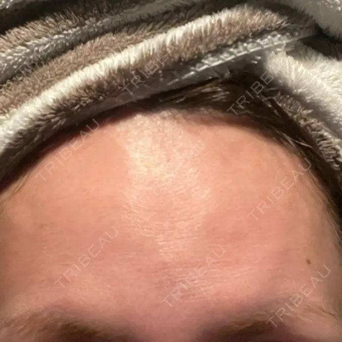 ボトックス（眉間） / ボトックス（額） X CLINIC 恵比寿院 AFTER メイン用