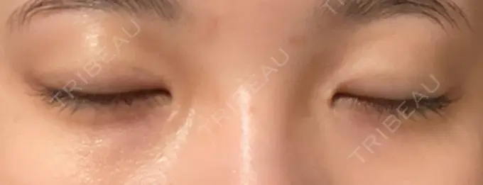 二重切開 こまちクリニック DAY 427 メイン用