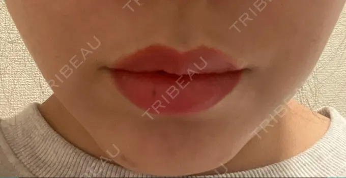 ボトックス（人中） veary clinic DAY 7 メイン用