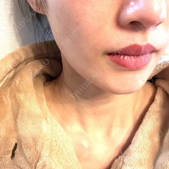 ピコレーザートーニング（美白・肝斑） ルラ美容クリニック 高田馬場院 AFTER メイン用