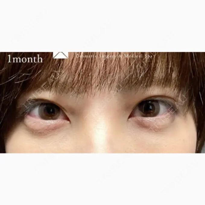 クマ治療 X CLINIC 福岡天神院 AFTER メイン用