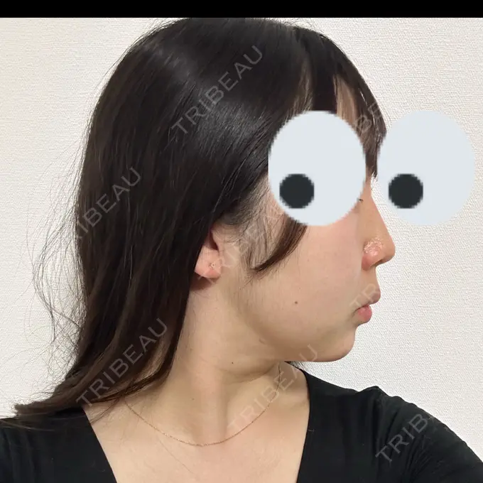 ヒアルロン酸注入（鼻） プライベートスキンクリニック 梅田本院 DAY 0 メイン用