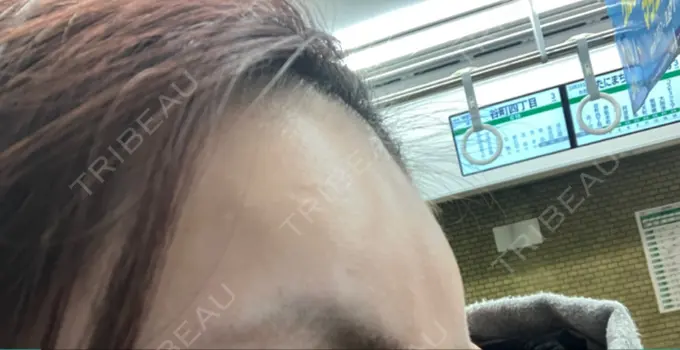 ヒアルロン酸注入（額） 吉井クリニック DAY 13 メイン用