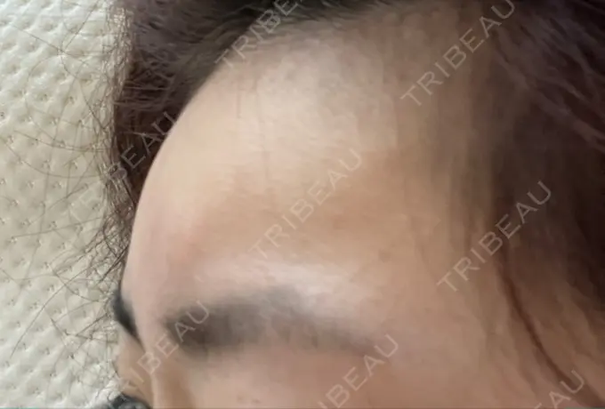 ヒアルロン酸注入（額） 吉井クリニック DAY 14 メイン用