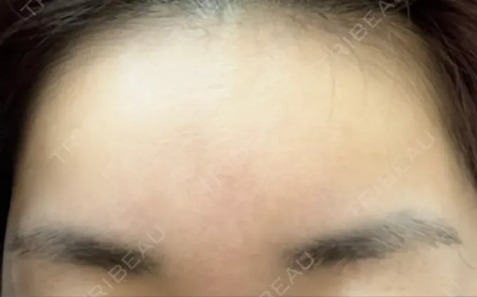 ヒアルロン酸注入（額） 吉井クリニック DAY 14 メイン用