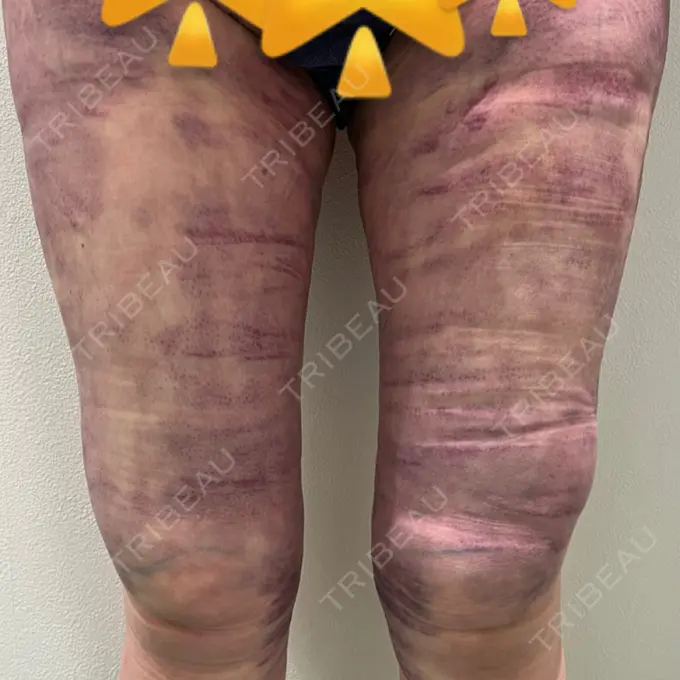 脂肪吸引（脚） Mods Clinic（モッズクリニック） 名古屋院 DAY 1 メイン用