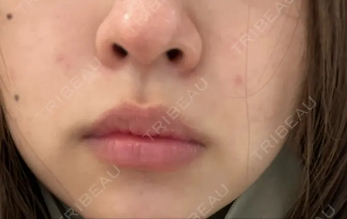 ピコレーザートーニング（美白・肝斑） ルラ美容クリニック 高田馬場院 DAY 1 メイン用