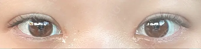 二重埋没 / 目頭切開 くさのたろうクリニック DAY 32 メイン用