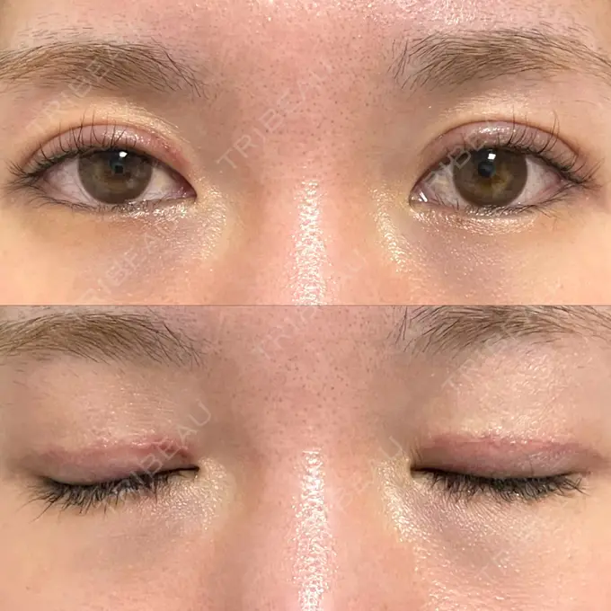 二重切開 / 上まぶたたるみ取り みずほクリニック DAY 50 メイン用