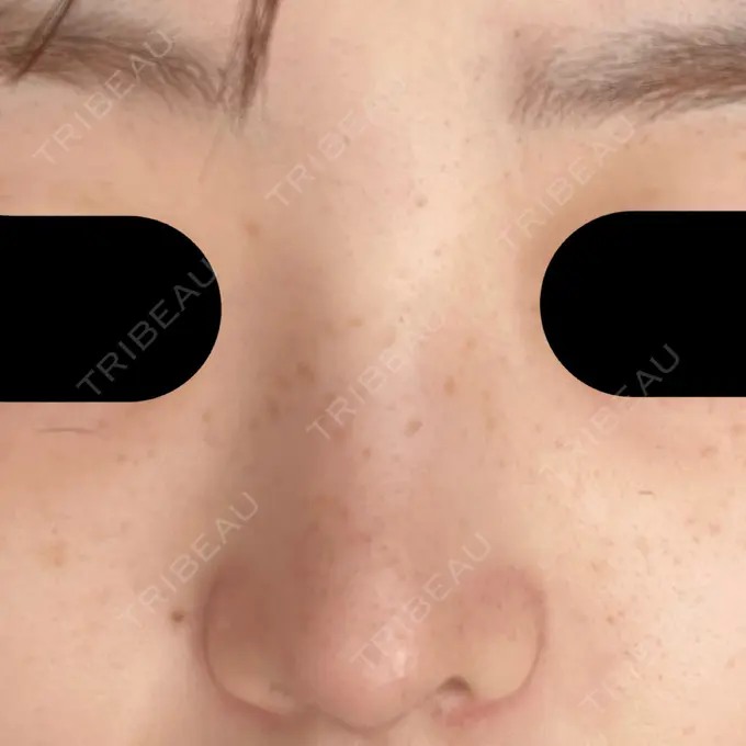 隆鼻術 / 鼻尖形成（切開） / 軟骨移植 / 鼻柱下降・鼻唇角形成（猫手術） グローバルビューティークリニック 大阪院 AFTER メイン用