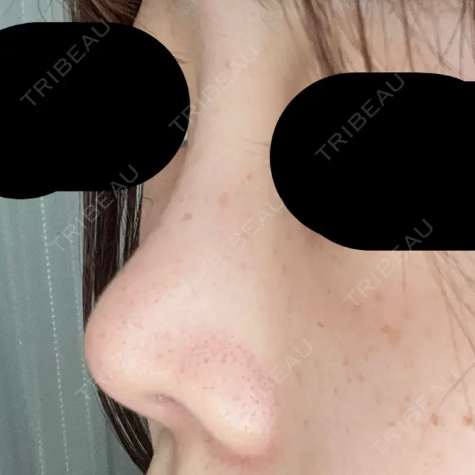 隆鼻術 / 鼻尖形成（切開） / 軟骨移植 / 鼻柱下降・鼻唇角形成（猫手術） グローバルビューティークリニック 大阪院 DAY 49 メイン用