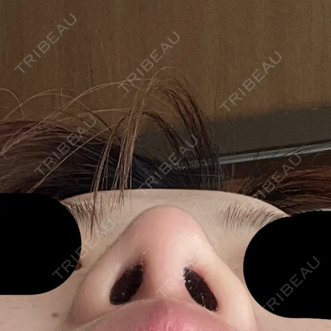 隆鼻術 / 鼻尖形成（切開） / 軟骨移植 / 鼻柱下降・鼻唇角形成（猫手術） グローバルビューティークリニック 大阪院 DAY 49 メイン用