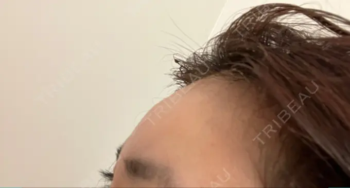 ヒアルロン酸注入（額） 吉井クリニック DAY 15 メイン用