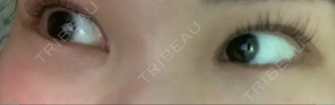 下まぶたの脂肪取り 吉井クリニック AFTER メイン用