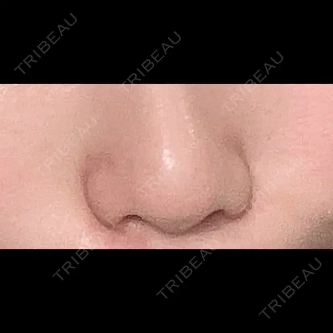 小鼻縮小（切開） 吉祥寺アイビークリニック AFTER メイン用